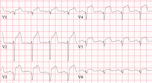anterior myocardial infarction ecg